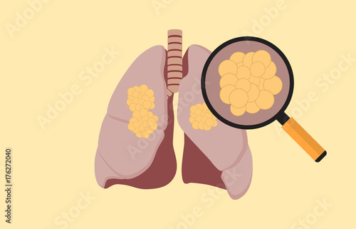 lung cancer with cancer cell on the lung and magnifying glass