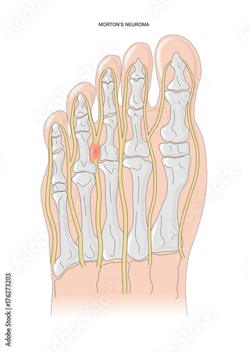 Morton's neuroma, or Morton metatarsalgia, a benign tumor of plantar nerves. photo