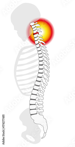 Neck pain - spinal disc herniation or prolapse at a human cervical vertebrae - profile view. Isolated vector illustration on white background.
