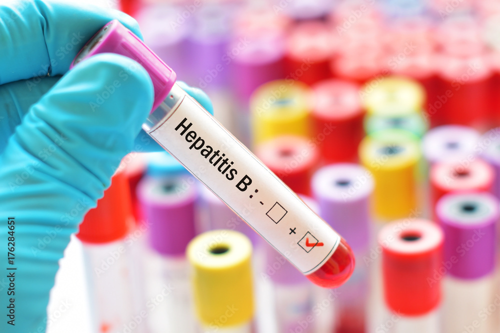 Fototapeta premium Blood sample with hepatitis B virus (HBV) positive