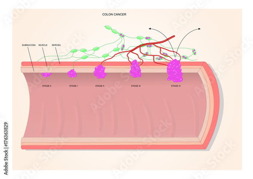 colon cancer in its various stages, according to the TMN system
