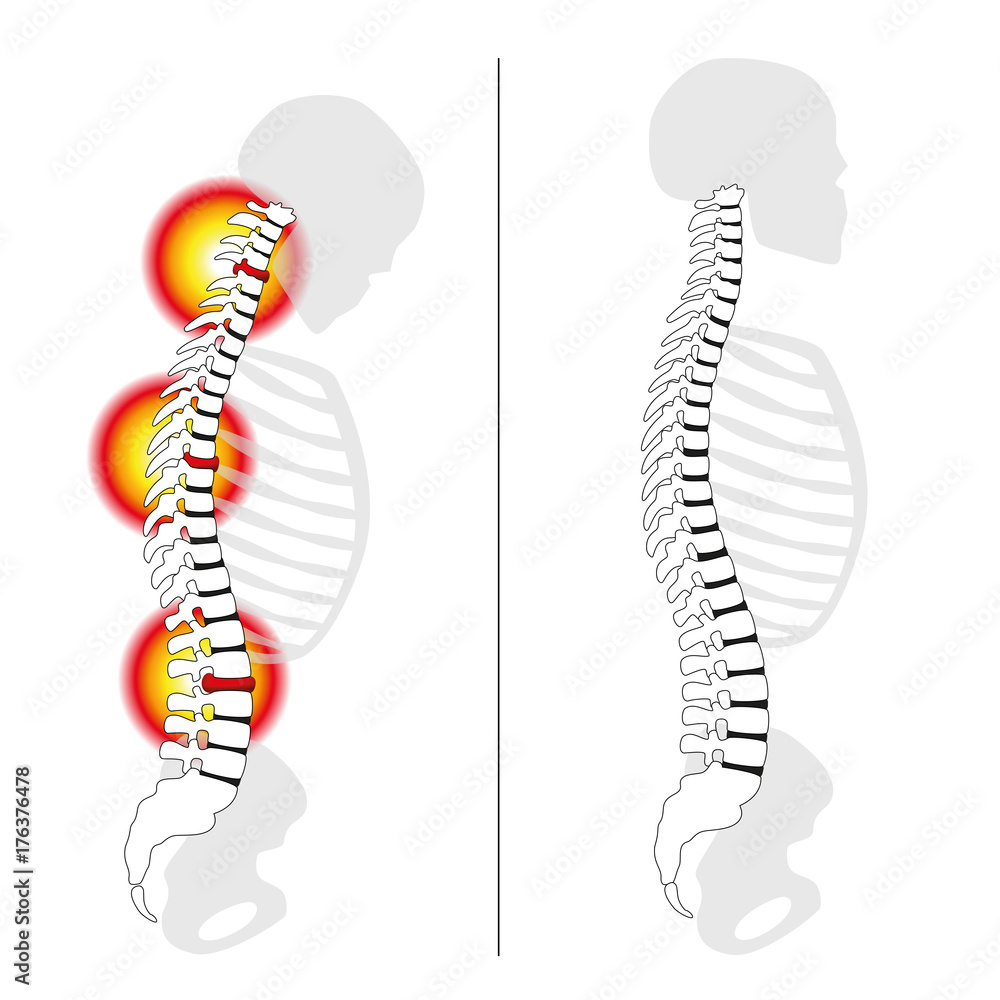 Slipped disc prolapses, curved back, severe back pain profile views