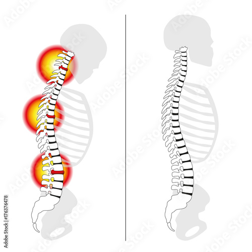 Slipped disc prolapses, curved back, severe back pain - profile views of spinal disc herniation versus upright healthy back - isolated vector illustration on white background.