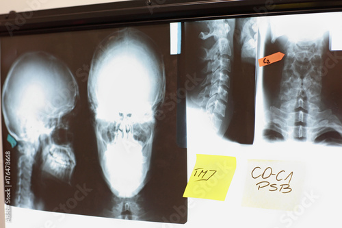 Images of skull and spine with notes at x-ray film viewer. Diagnosis,treatment planning