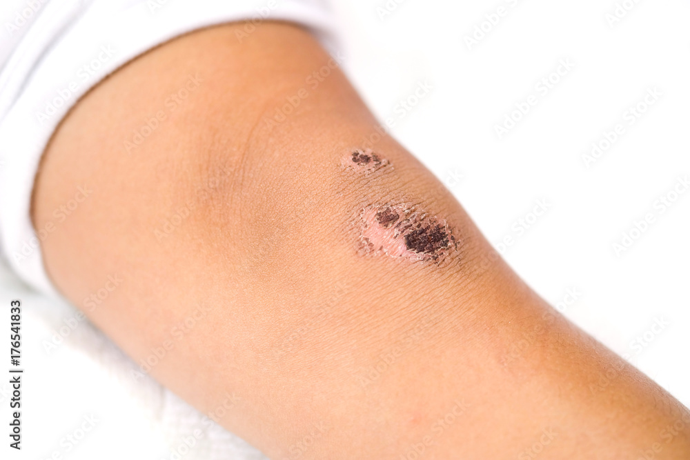 Fototapeta premium wound scab of a child's knee on a white background