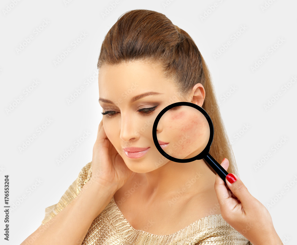 Post-Acne Marks /Treating Acne Scars.Acne Scar Removal Post-Acne Marks /Treating Acne Scars.Acne Scar Removal