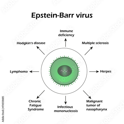 Epstein-Barr virus. Diseases caused by a virus. Infographics. Vector illustration