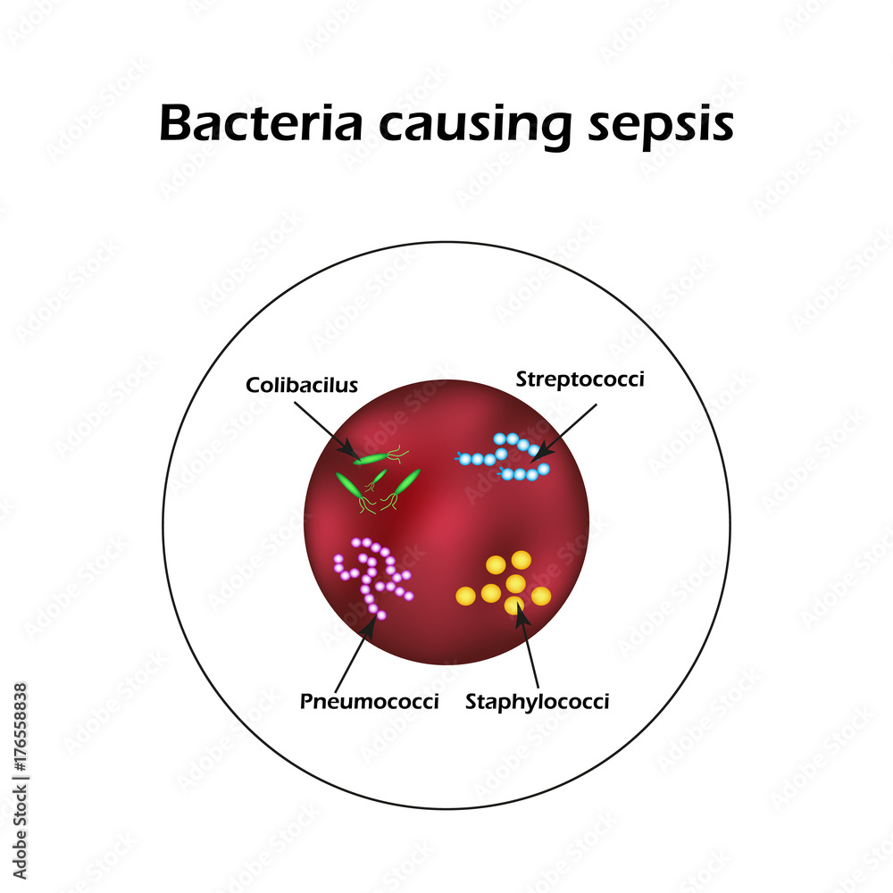 sepsis-blood-poisoning-e-coli-streptococci-pneumococci