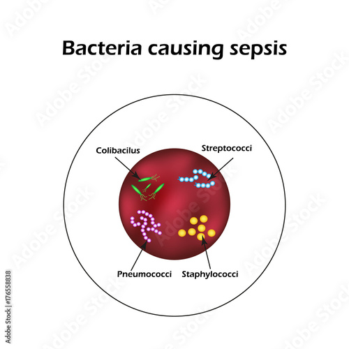 Sepsis. Blood poisoning. E. coli. Streptococci. Pneumococci. Staphylococci. Infographics. Vector illustration