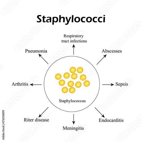 Staphylococci. Staphylococcus aureus causes diseases. Infographics. Vector illustration