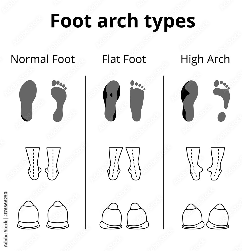 Foot arch types vector infographics. Set of flat foot, high arch Stock