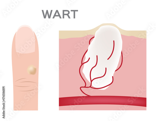 Wart on a person's hand close up