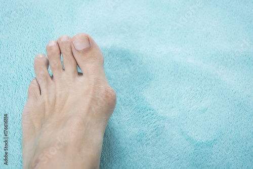 Hallux valgus, bunion in a leg on a blue soft background photo