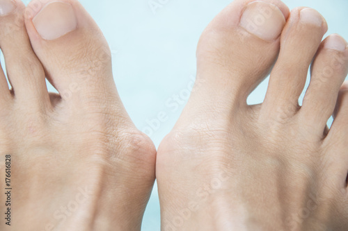 Hallux valgus, bunion in foot on white background