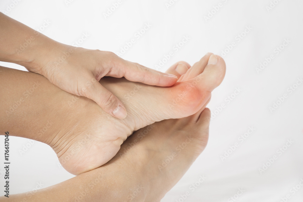 Fototapeta premium bunion in foot problem