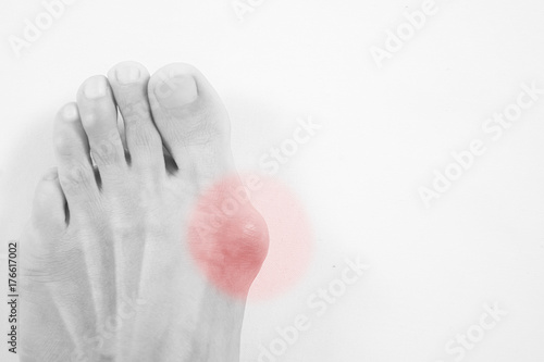 Hallux valgus, bunion in foot on white background