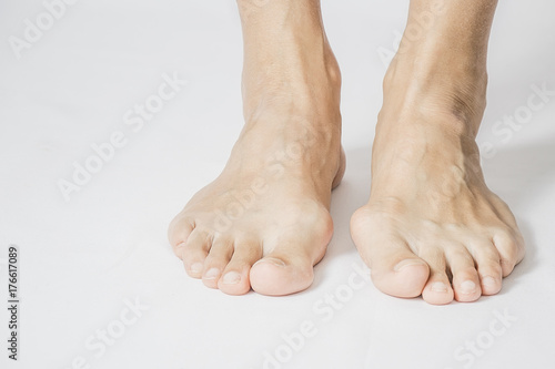 bunion in foot problem