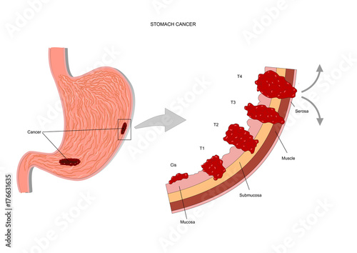 stomach cancer, or gastric cancer, in its various stages