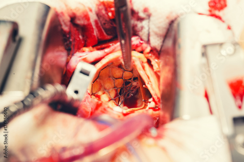 Fotografi minimally invasive surgical approach with a small incision for heart valve surge
