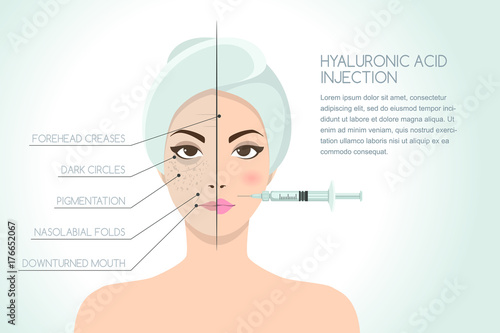 Before and after vector illustration of woman having hyaluronic acid facial injection. Vector infographics design template. Beauty, cosmetology, anti-aging concept.