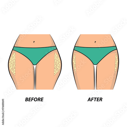Cellulite women's buttocks. Before and after diet or fitness. Vector illustration.