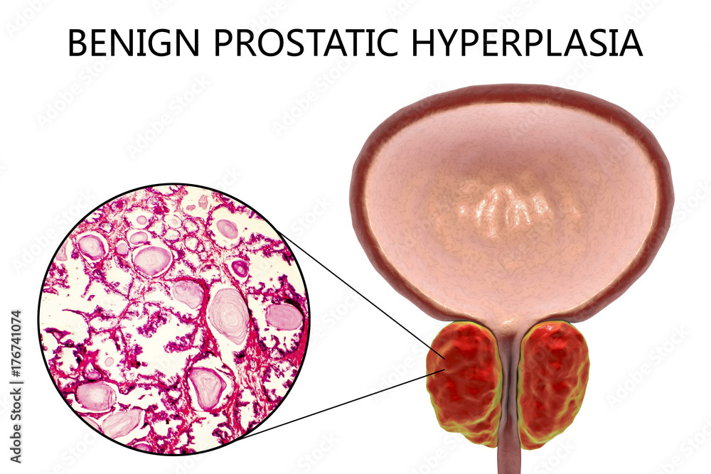 Bumpy Prostate Benign prostatic hyperplasia, 3D illustration showing enlarged prostate ...