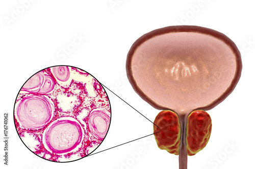 Benign prostatic hyperplasia, 3D illustration showing enlarged prostate gland and photomicrograph showing dilated glands, enfolding of the glandular epithelial cells, cystic dilatation photo