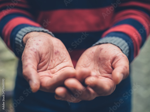 Close up on a man with spots on hands begging photo