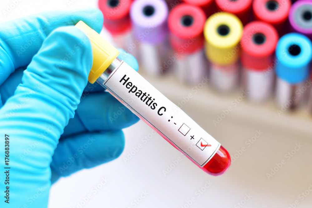 Obraz premium Hepatitis C virus testing positive