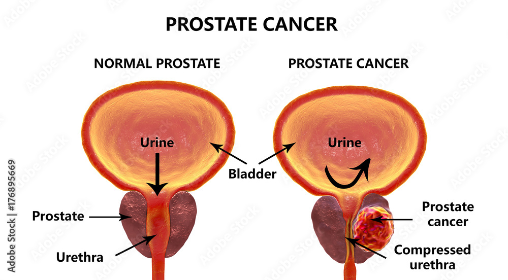 Prostate cancer, 3D illustration showing normal prostate gland and presence of tumor inside