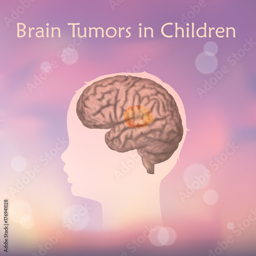 Brain tumors, cancer in infants, childhood. Vector medical illustration. Kid, baby, childhood. Blurred pink background, silhouette of child head, anatomy image.