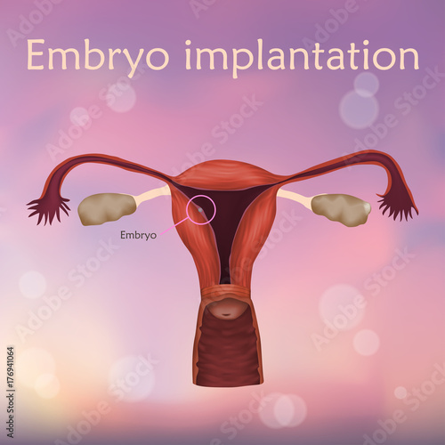 Embryo implantation. The fertilized egg, uterus, womb. Anatomy illustration. Blurred pink background.