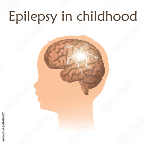 Epilepsy in infants, childhood. Vector medical illustration. Kid, baby, childhood. White background, silhouette of child head, anatomy image of brain, electrical discharge.