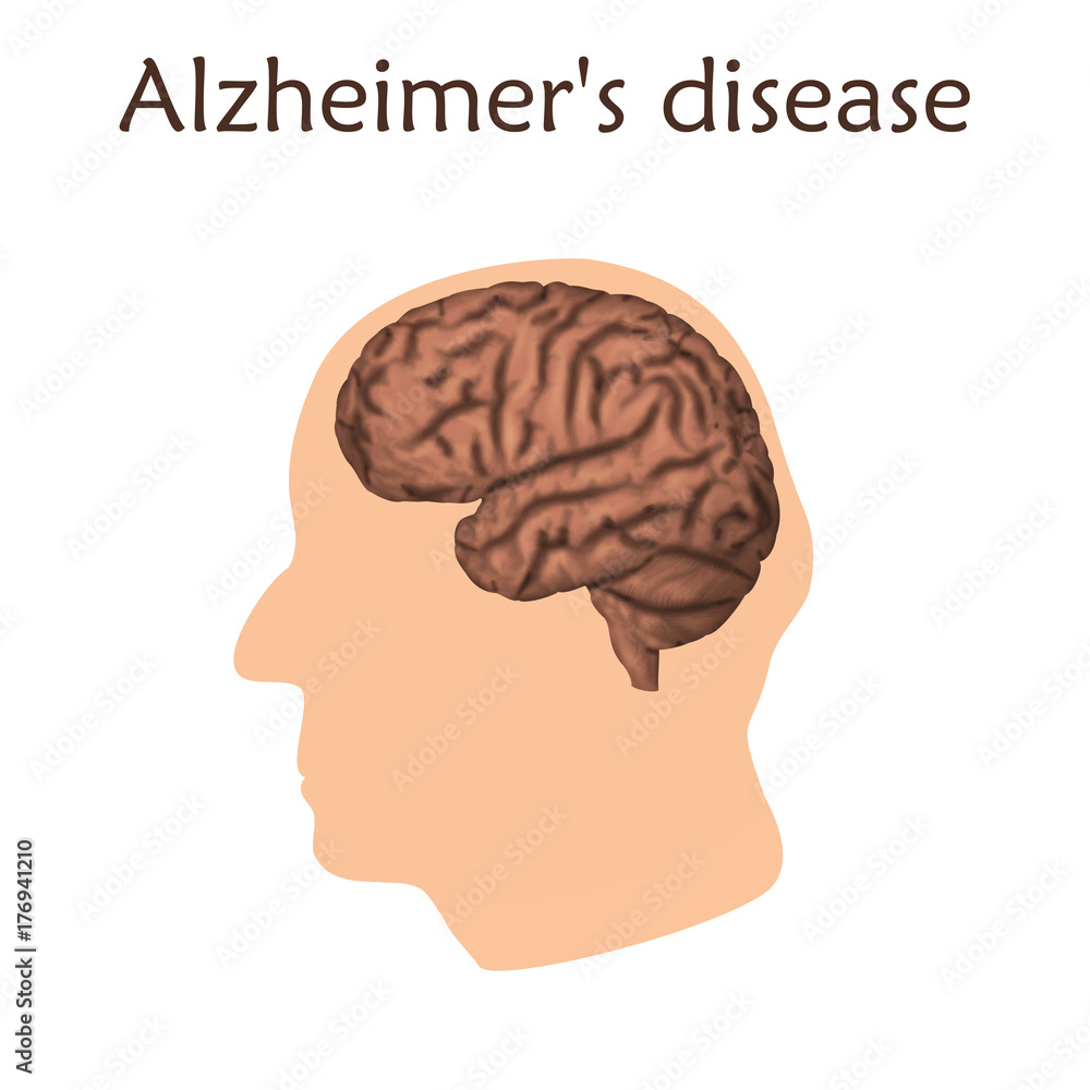 Alzheimer Stock Photos, Images and Backgrounds for Free Download