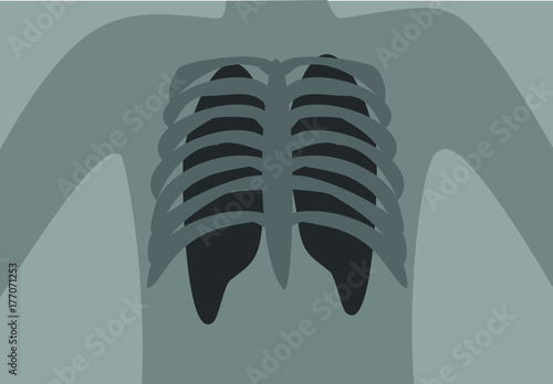 Chest x-ray illustration