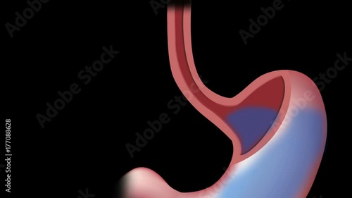 Gastric reflux (GERD) animation.