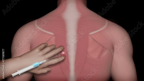 Trigger point injection, animation