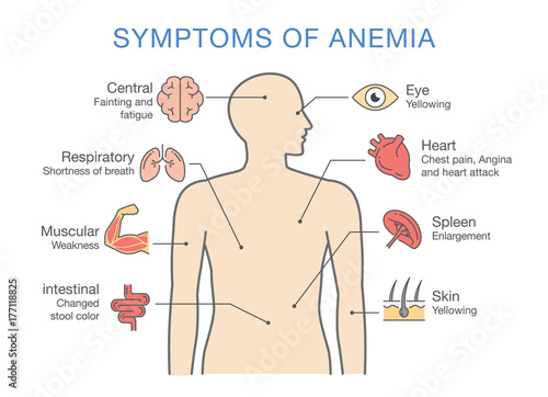 Symptoms common to many types of Anemia. Illustration about medical diagram for diagnose a disease or condition. photo