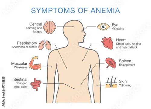 Symptoms common to many types of Anemia. Illustration about medical diagram for diagnose a disease or condition.