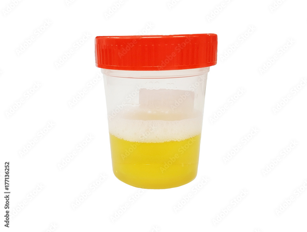 Urine sample in container isolated on white background with clipping