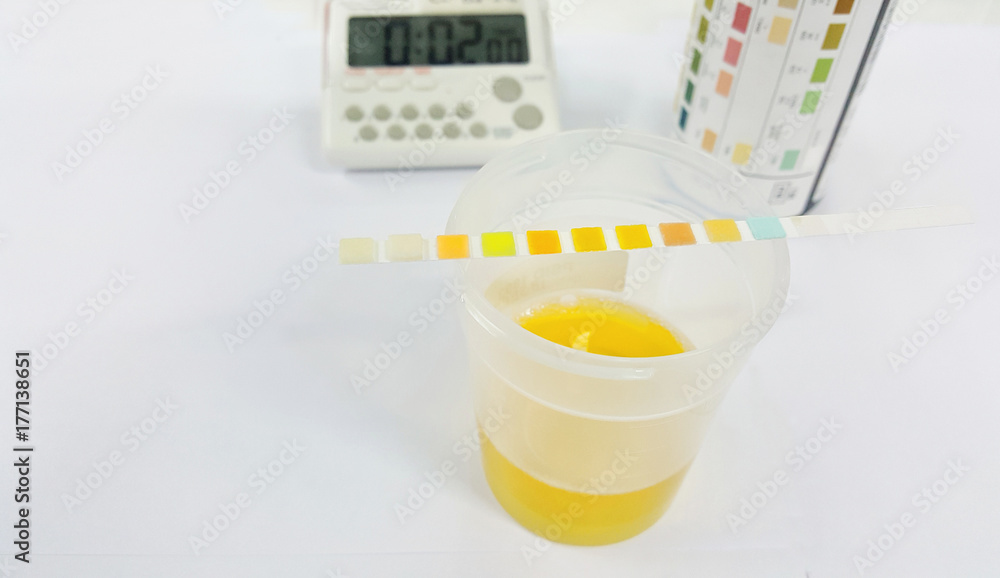 Foto Stock Urine test strip or dipstick test used to determine