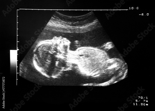 Twenty week ultrasound scan of a healthy female foetus. photo