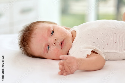 Adorable baby with skin allergy indoors