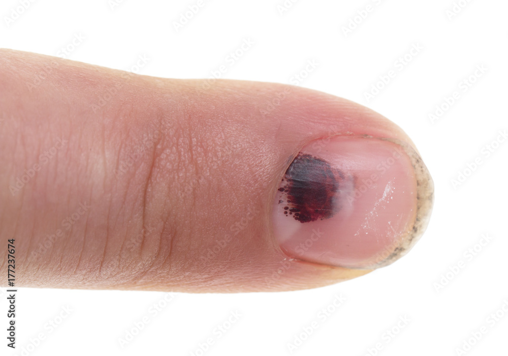 Fototapeta premium bruise on the finger