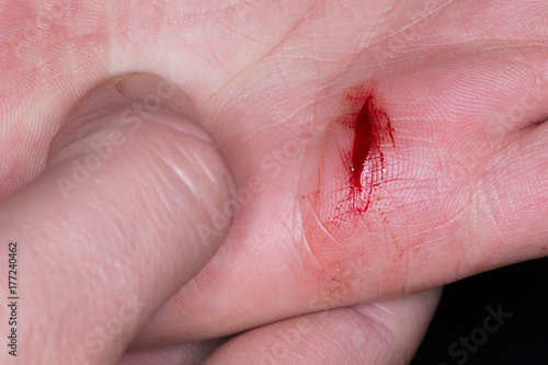 Valokuva deep cut caused by knife in hand palm