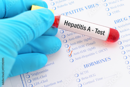 Blood sample with requisition form for hepatitis A virus (HAV) test