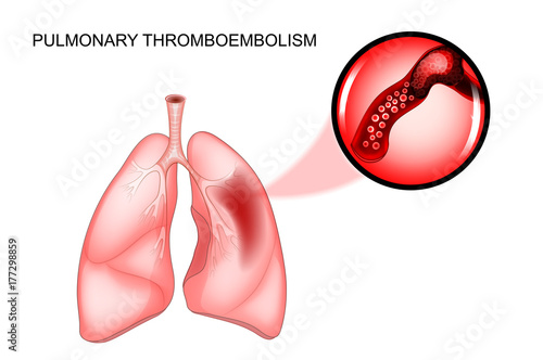 pulmonary thromboembolism. thrombosis photo