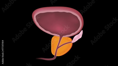 Benign prostatic hyperplasia (BPH) animation