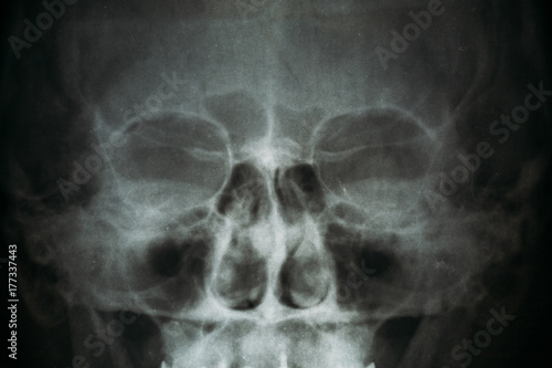 Tableau sur toile X-ray image or roentgen of human skull, close-up