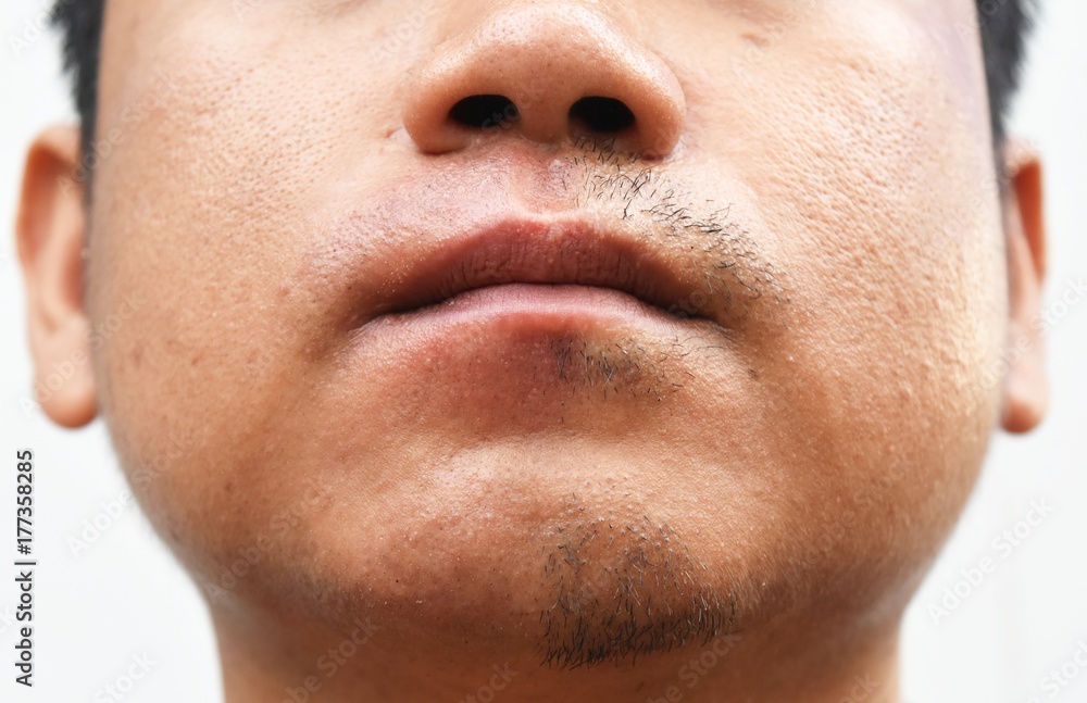 some mustache after withdrawal mustache on surface young asian man face skin do not take care for a long time